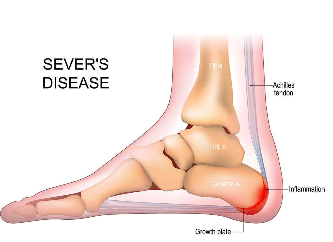 Heel Pain | Plantar Fasciitis | Achilles Tendonitis | Fractures | Severs  Disease | Bursitis | Arthritis | FootSmart Podiatry