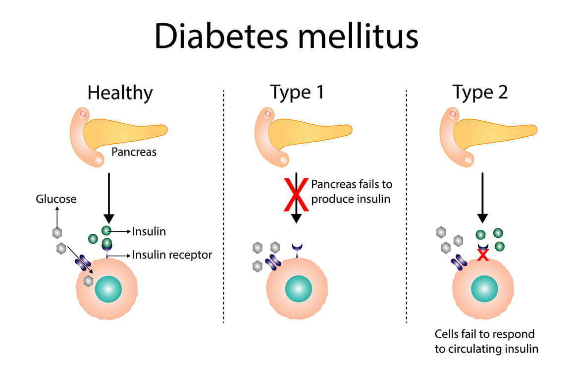 Type 2 Diabetes Mellitus Vector Health