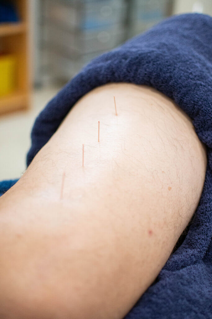 dry needling 