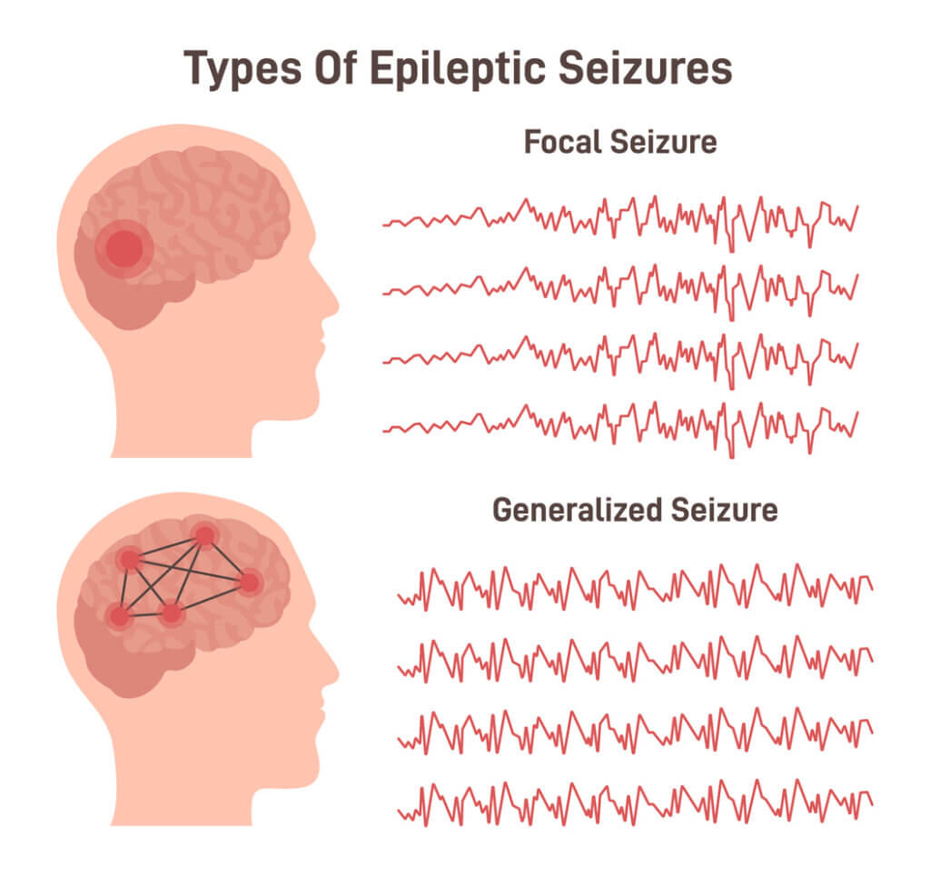 epilepsy